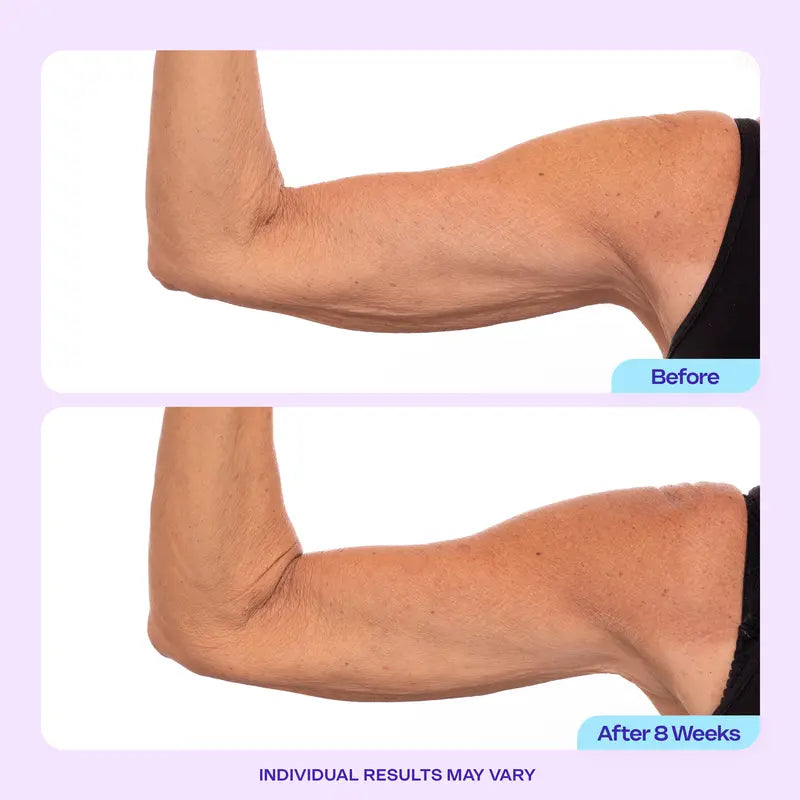 Visibly Firm & Tighten Loose Arm Skin