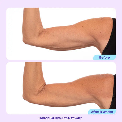 Visibly Firm & Tighten Loose Arm Skin