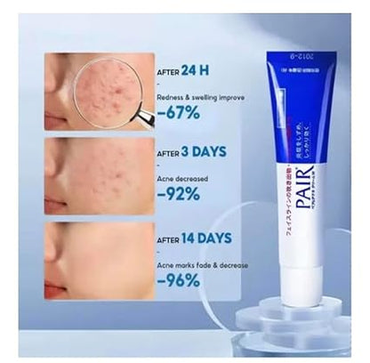 Eliminate Sudden Breakouts Fast with Japanese Anti-Acne Treatment Cream for Clear Smooth Skin