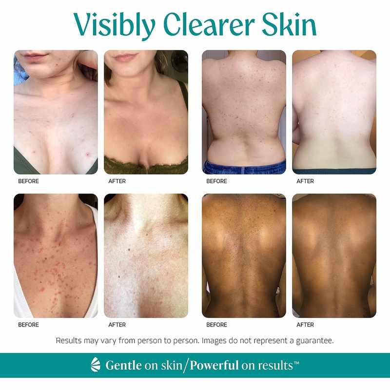 [🎁 BUY 1 GET 1 FREE] Advanced 15% Mandelic Acid Exfoliating Serum for Clearer, Smoother Skin