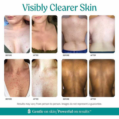 [🎁 BUY 1 GET 1 FREE] Advanced 15% Mandelic Acid Exfoliating Serum for Clearer, Smoother Skin