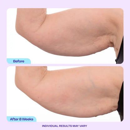 Visibly Firm & Tighten Loose Arm Skin
