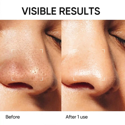 Effortlessly Dissolve Stubborn Blackheads and Shrink Pores for Flawless Clear Skin Instantly