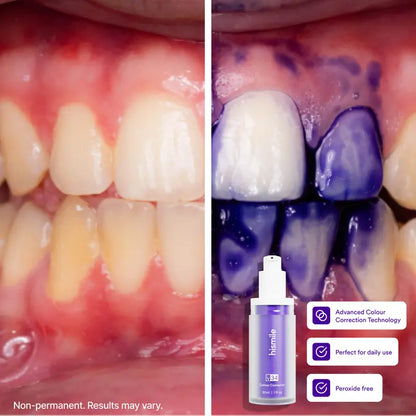 Purple Teeth Colour Corrector Serum – Fast Purple Correction For A Brighter Whiter-Looking Smile