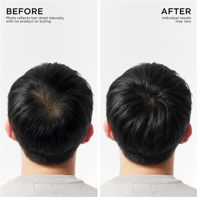 Hair Thickening Serum Set – Prebiotic Scalp Revitalizing Treatment For Advanced Hair Thinning Control