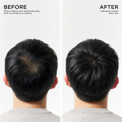 Hair Thickening Serum Set – Prebiotic Scalp Revitalizing Treatment For Advanced Hair Thinning Control