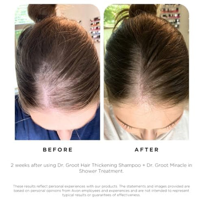 Hair Thickening Serum Set – Prebiotic Scalp Revitalizing Treatment For Advanced Hair Thinning Control