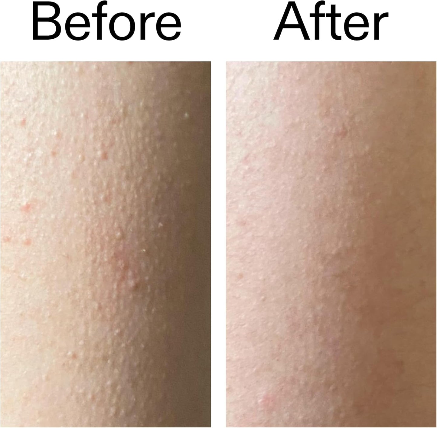 Glycolic Acid Exfoliating Body Stick For Smooth, Bump-Free Skin